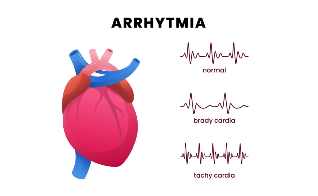 Arrhythmias